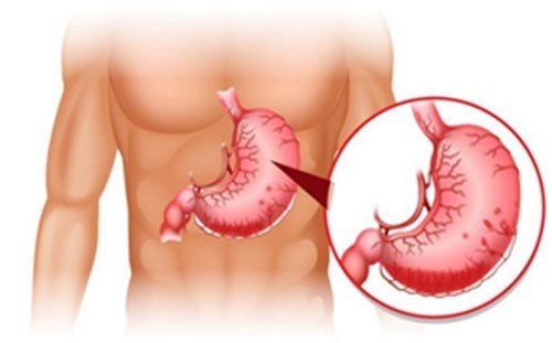 Những bài thuốc dân gian chữa đau dạ dày