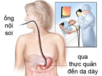nội soi dạ dày xét nghiệm HP
