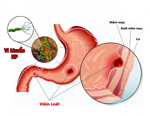 điều trị ngắt quãng làm tăng nguy cơ tái phát đau dạ dày