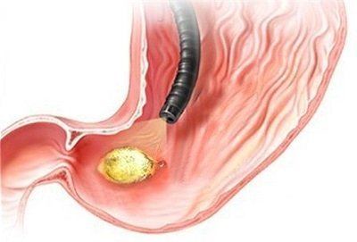 biến chứng của đau dạ dày
