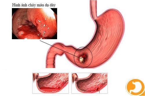 thủng dạ dày