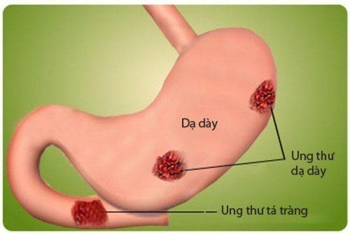 biến chứng của đau dạ dày nặng nhất