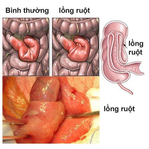 bệnh lồng ruột