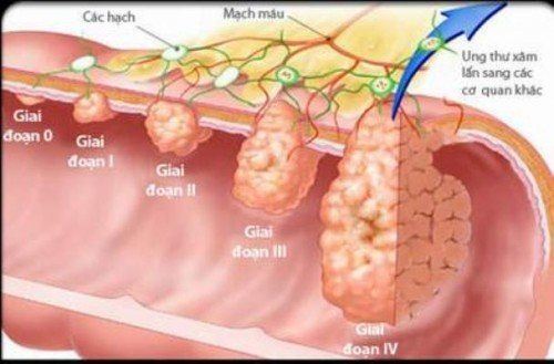 phát hiện ung thư dạ dày sớm