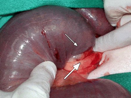 cận cảnh bệnh lồng ruột