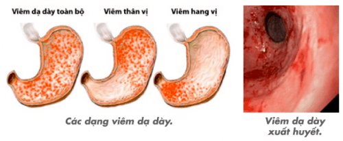 viêm trợt hang vị dạ dày