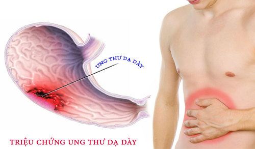 triệu chứng ung thư dạ dày