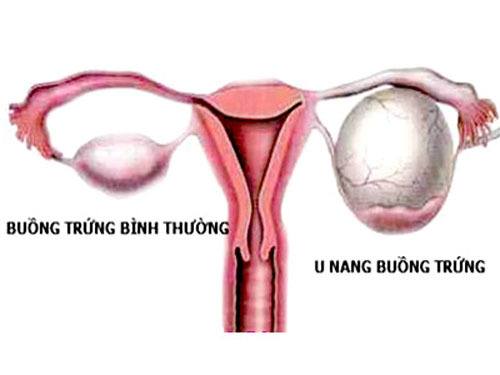 u nang buồn trứng gây đau bụng dưới