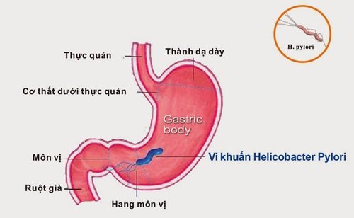 viêm hang vị dạ dày