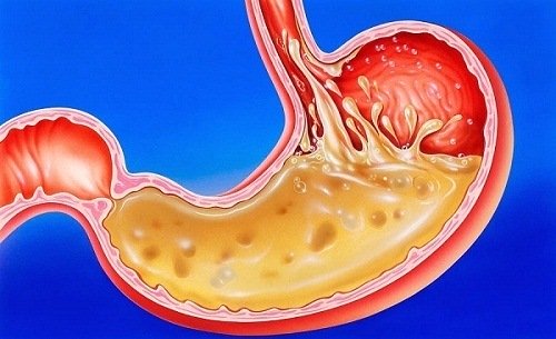 giảm axit dạ dày tự nhiên