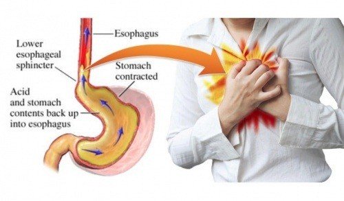 bệnh trào ngược dịch vị dạ dày