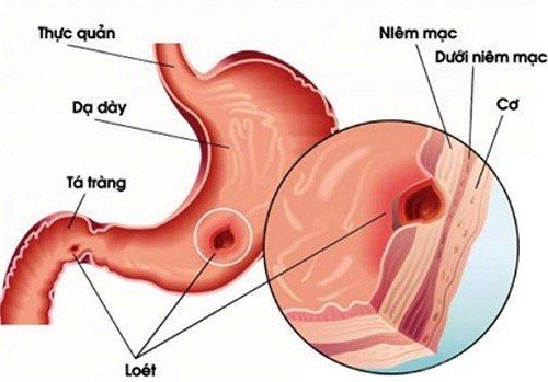 viêm loét niêm mạc dạ dày