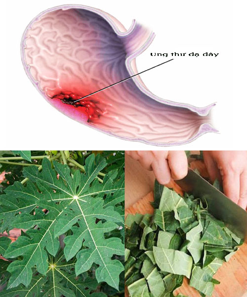 chữa ung thư dạ dày bằng thuốc nam