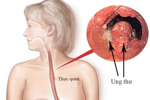 ung-thu-thuc-quan