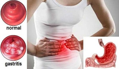 viêm loét dạ dày