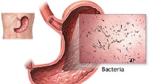 Viêm dạ dày ruột cấp tính