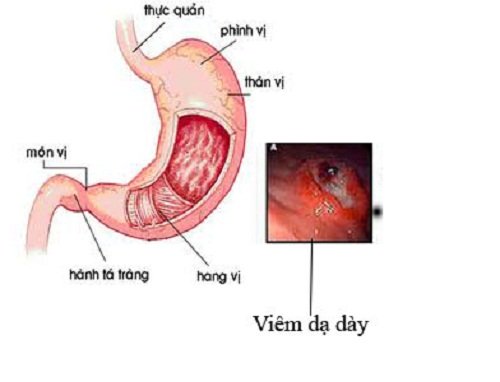 đầy bụng khó tiêu buồn nôn