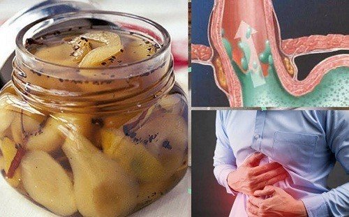Chữa trào ngược dạ dày