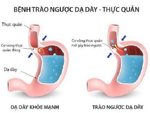trào ngược dạ dày