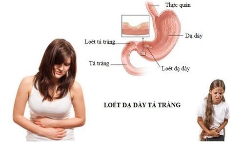 viem-loet-da-day--tre-em