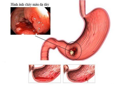 đau dạ dày có nguy hiểm không