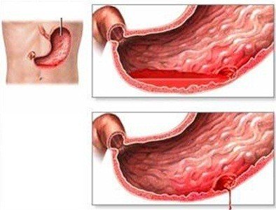 đau dạ dày cấp có thể trở thành mãn tính