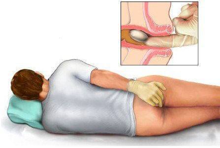 bệnh trĩ gây đau rát hậu môn