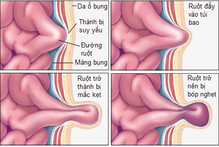 những biến chứng của thoát vị rốn ở trẻ sơ sinh