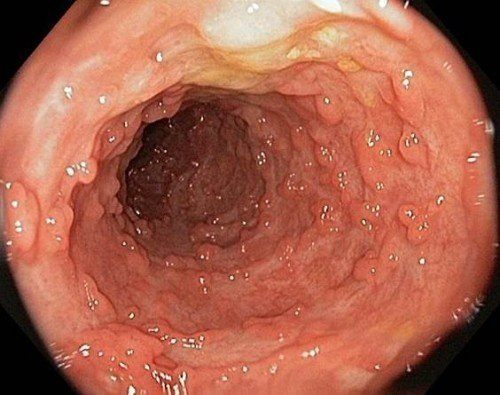 polyp trực tràng gây đau rát hậu môn