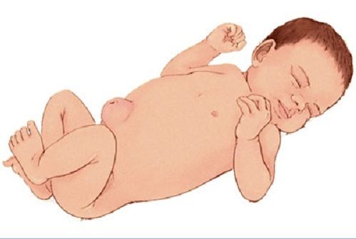 thoát vị rốn ở trẻ sơ sinh