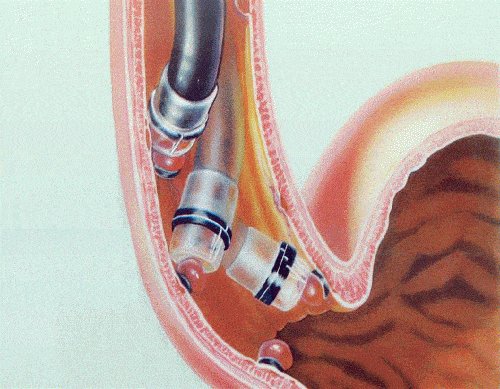 điều trị bệnh giãn tĩnh mạch thực quản