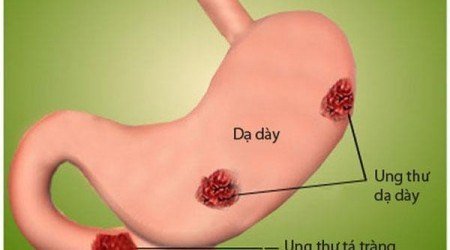 điều trị ung thư dạ dày bằng xạ trị