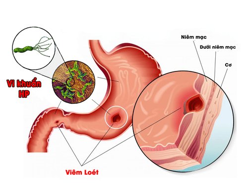Có nhiều nguyên nhân gây nên bệnh dạ dày
