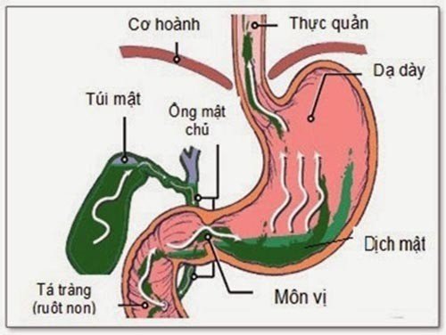 Mô phỏng bệnh trào ngược dịch mật
