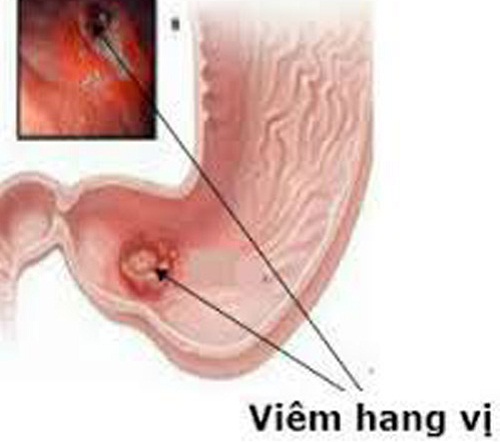 viêm niêm mạc hang vị dạ dày