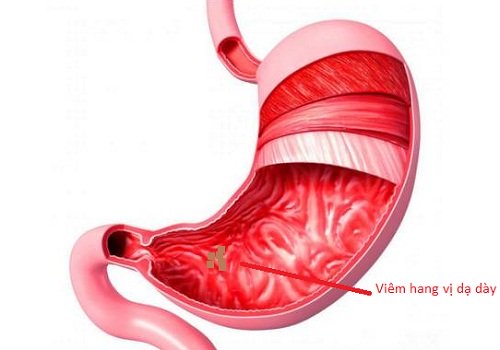 viêm hang vị dạ dày