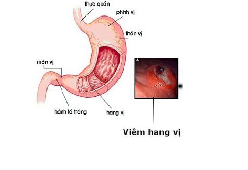 Viêm xung huyết hang vị dạ dày