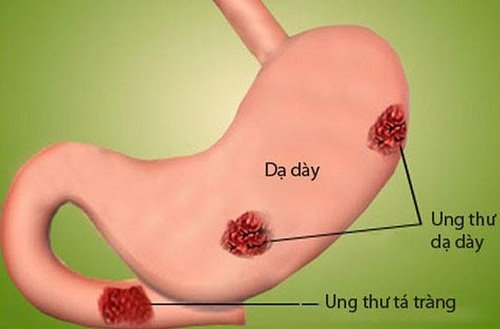 ung thư dạ dày di căn