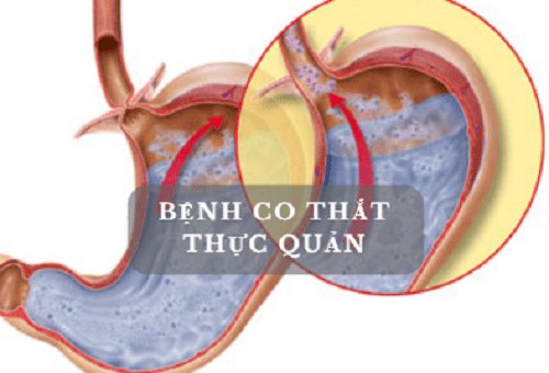 Co thắt thực quản