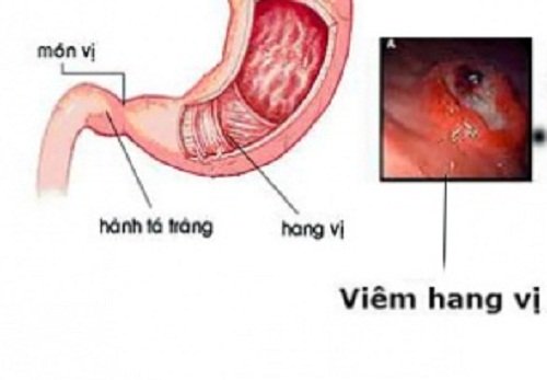 viêm hang vị