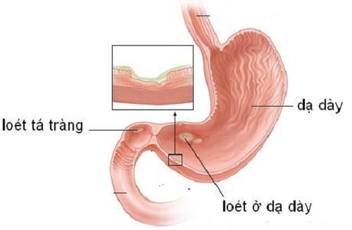 Viêm loét dạ dày tá tràng