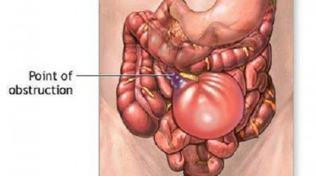 Hội chứng tắc ruột
