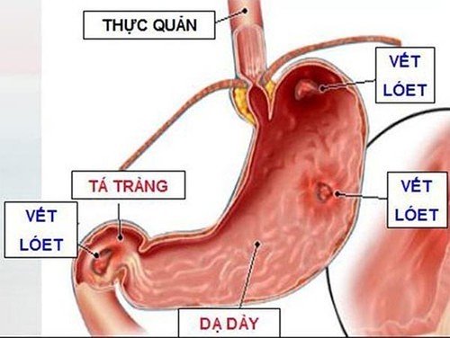 Vì sao Almagate có tác dụng tốt trong điều trị triệu chứng bệnh dạ dà