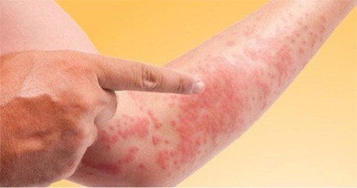Các tác dụng không mong muốn khi sử dụng thuốc Nexium điều trị bệnh