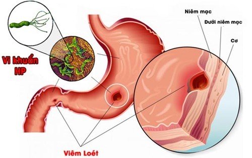 Tìm hiểu về các xét nghiệm vi khuẩn HP