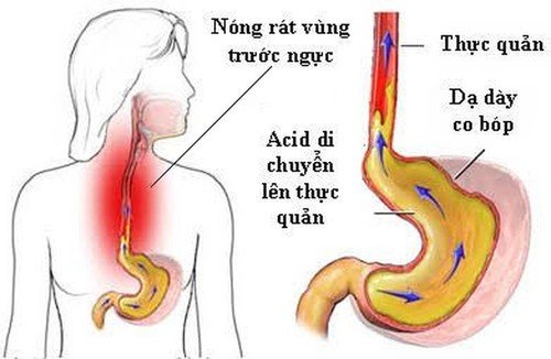 Hiểu về chứng trào ngược dạ dày và cách điều trị